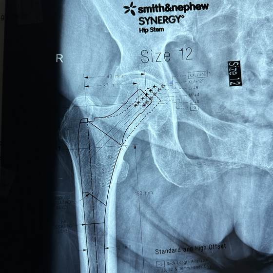 Caso real de artroplastia de cadera 05