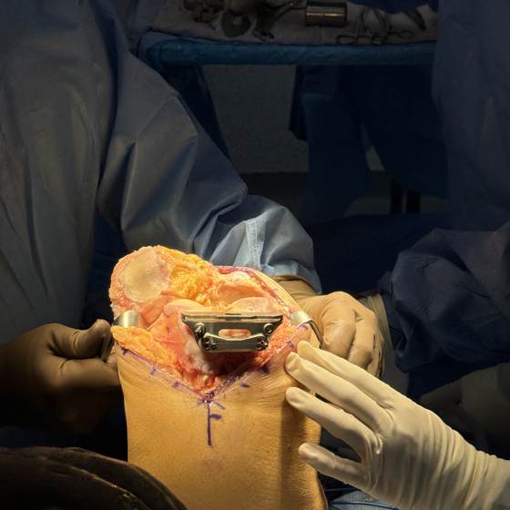 Caso real de artroplastia de rodilla 10